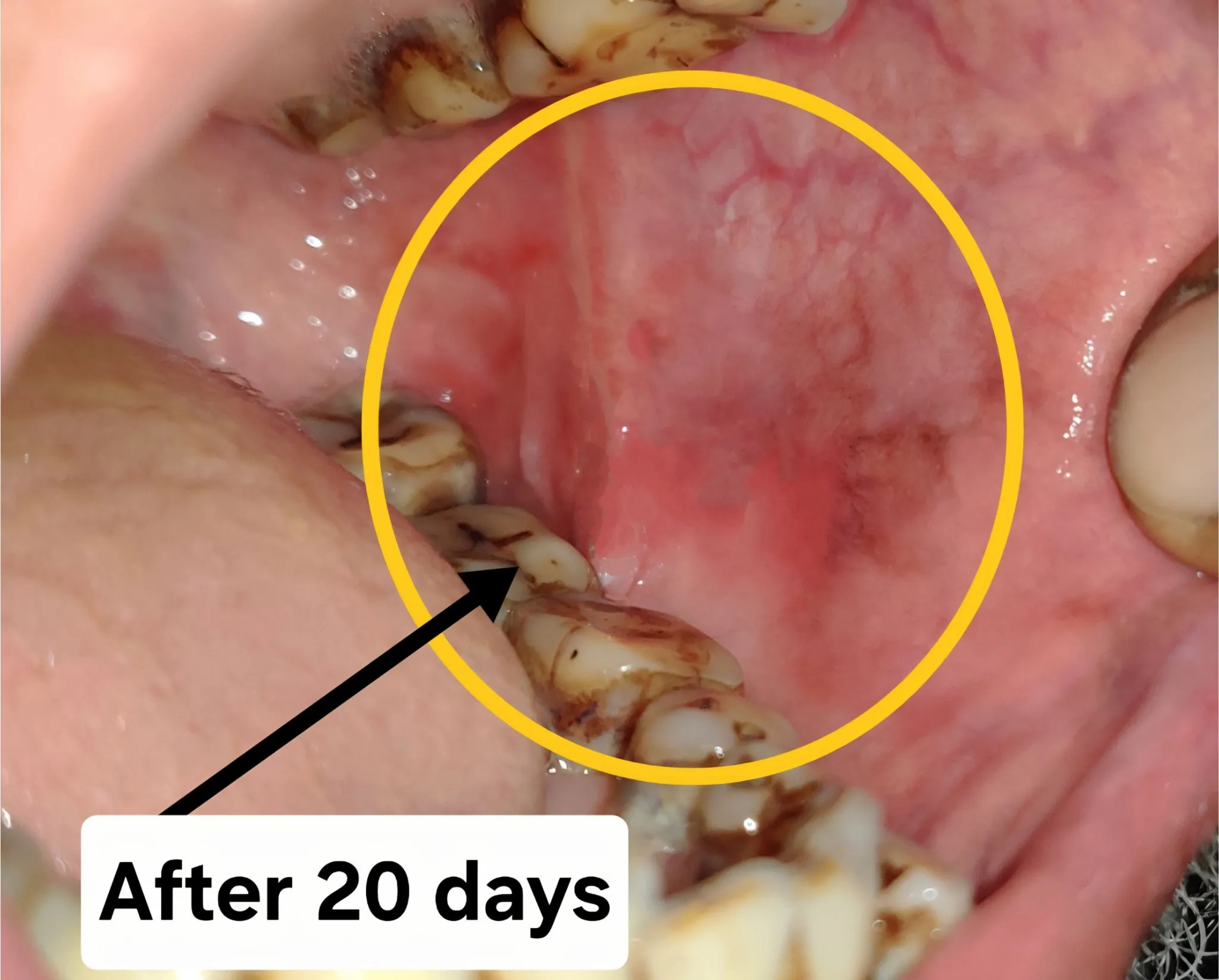 After Treatment Result - Oral Leukoplakia Laser Healing