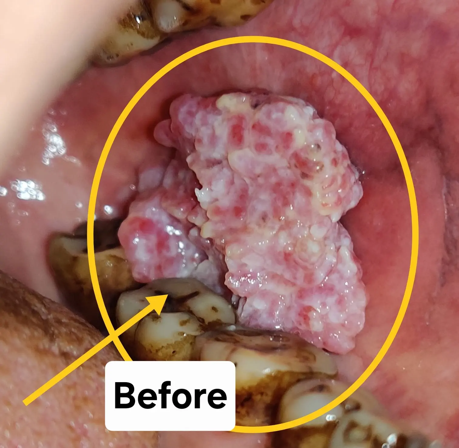 Before Treatment Condition - Oral Leukoplakia White Patch